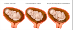 Types Of Placenta Uterus 1 300x126 