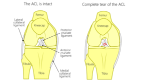 ACL Reconstruction: What You Need to Know