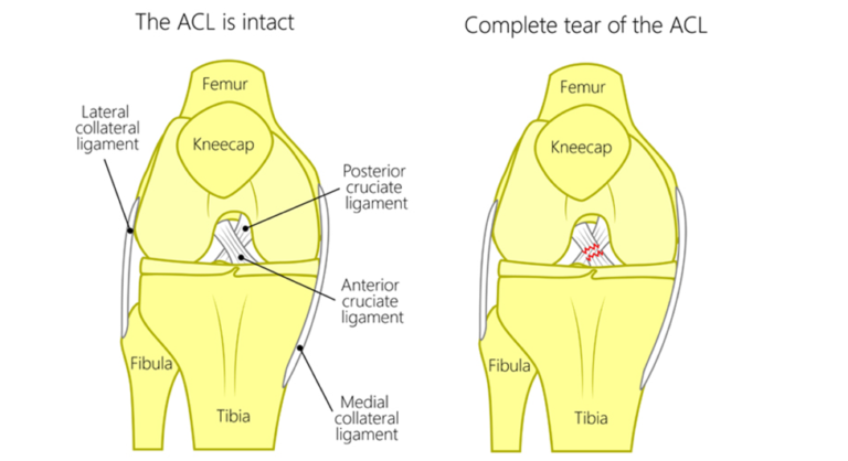 ACL Reconstruction: What You Need to Know