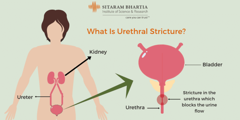 urethral-stricture-why-you-may-have-problems-passing-urine