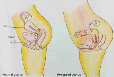 Prolapse