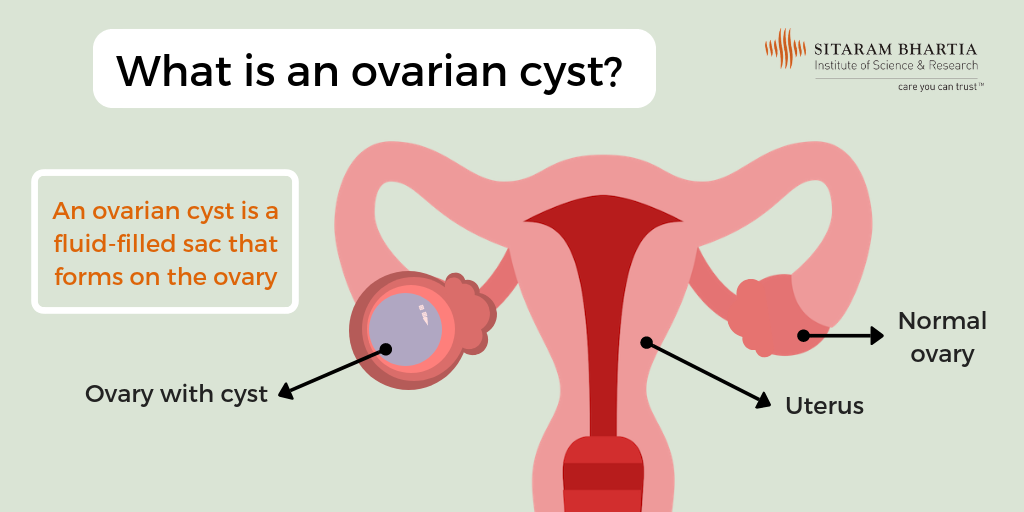 grapefruit size ovarian cyst