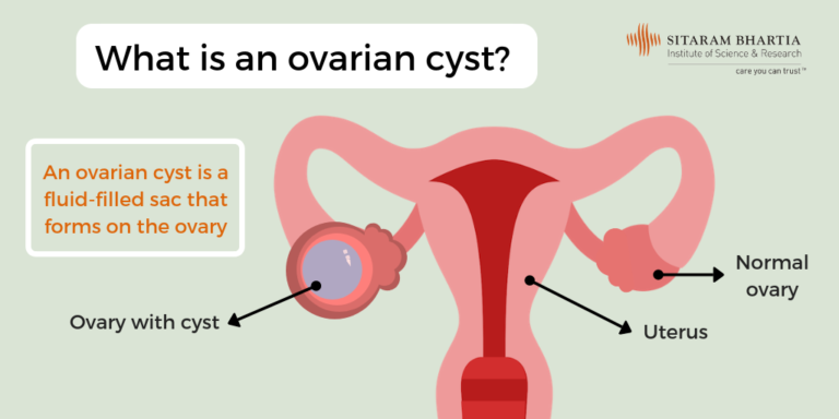 Ovarian Cyst - Is Surgical Treatment The Right Option?