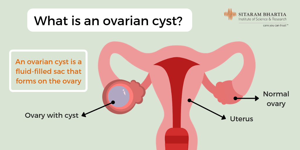 pin-on-cyst-on-ovary