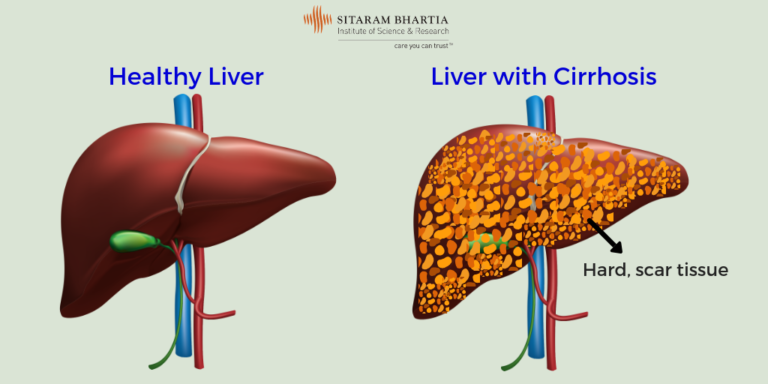 liver-cirrhosis-in-hindi