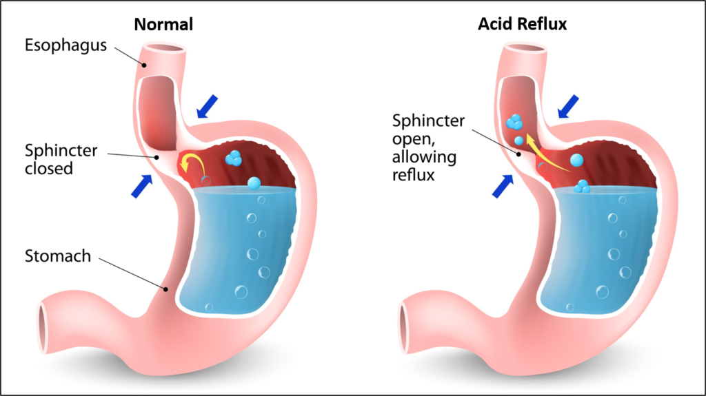 How to Prevent Hernia: Essential Tips You Should Know - Sitaram Bhartia ...