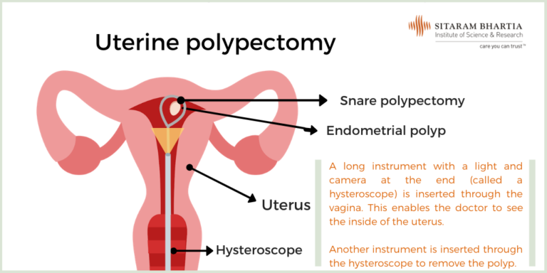 Dont Be Afraid Of A Polypectomy Heres What To Know Sitaram Bhartia Blog 8312